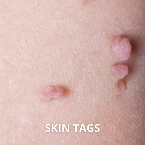 SKIN TAGs