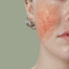 rosacea concern
