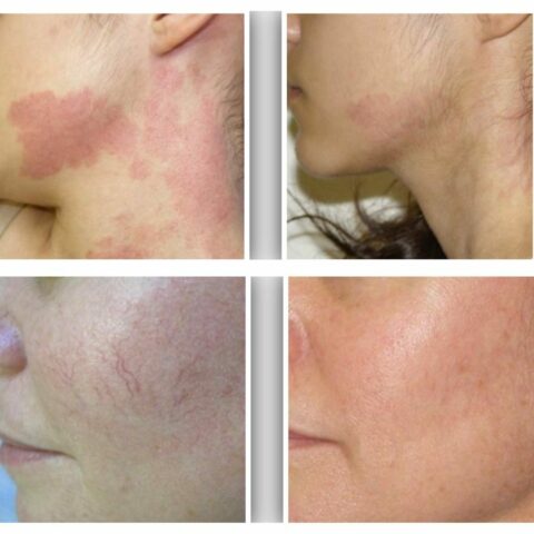 Rosacea before and after