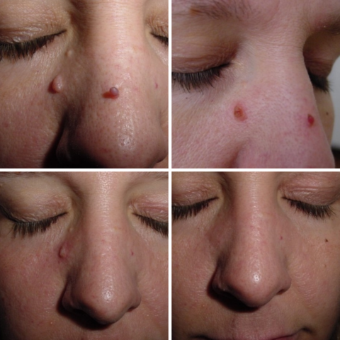 skin tag removal before and after