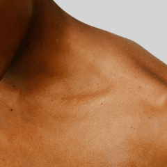 Laser hair removal for men