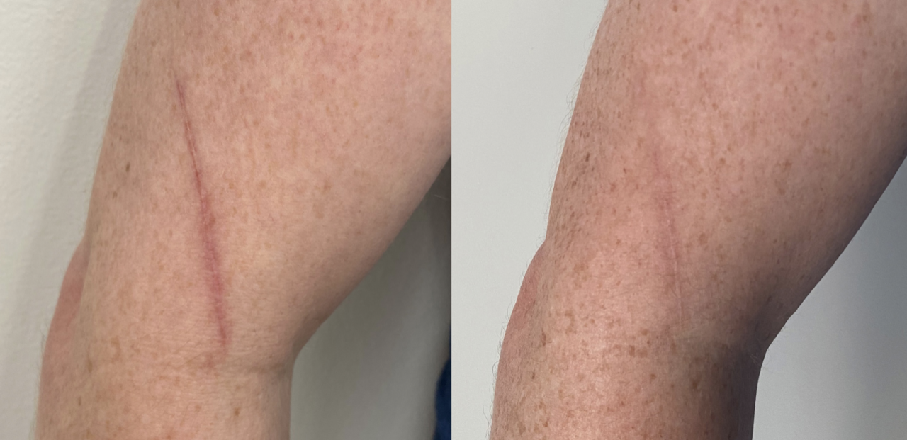 ipixel scar removal