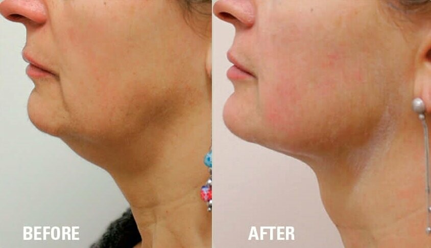 HIFU SKIN TIGHTENING LONDON