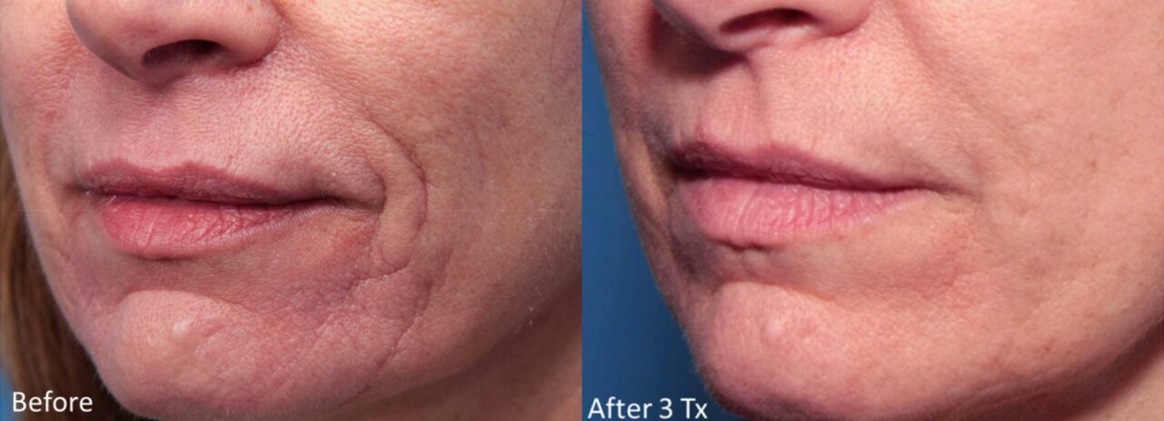 radiofrequcy micro needling