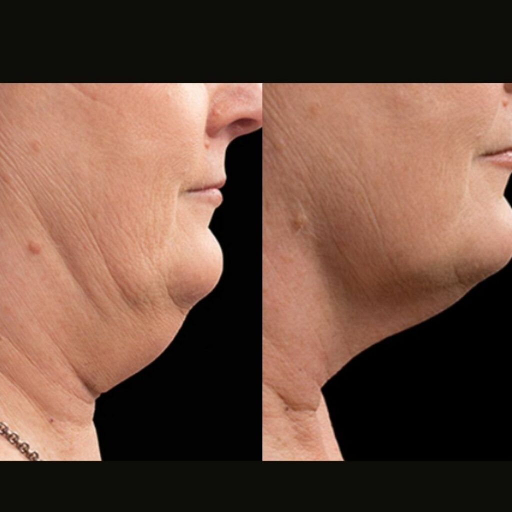 Double chin before and after with CoolSculpting