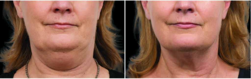 CoolSculpting double chin