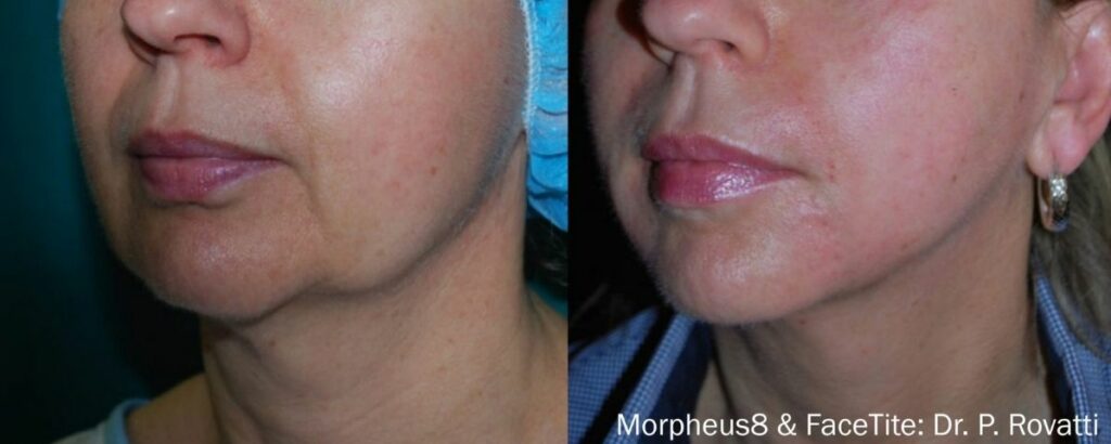 Double chin before and after with Morpheus