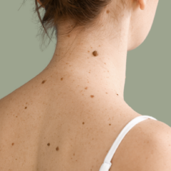 mole removal
