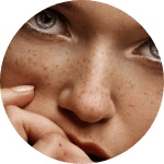 Treat my hyperpigmentation