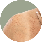 Get rid of my sun damage
