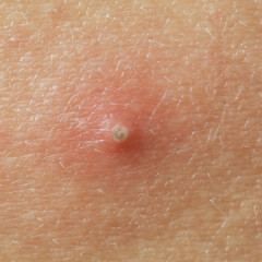 Ingrown hairs treatment FI