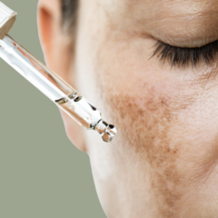 melasma pigmentation