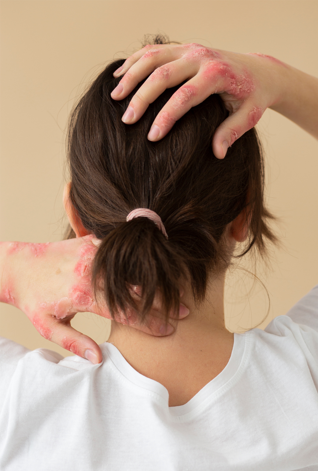 Psoriasis Treatment in page image