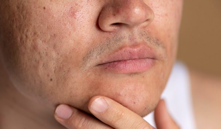 Revolutionising Acne Treatment