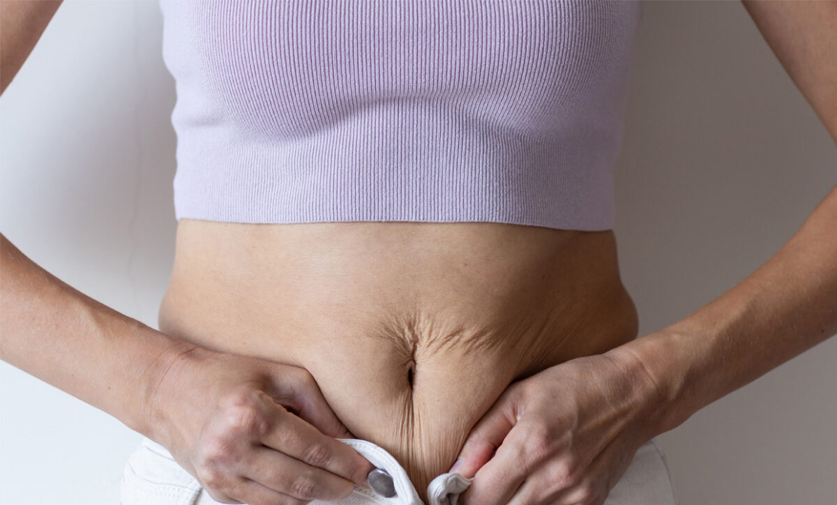 5 Ways to Tighten Stomach Skin