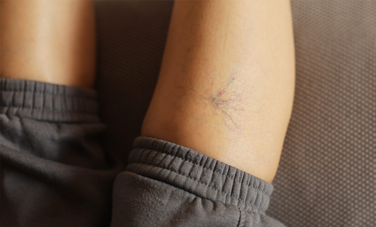 Spider Veins and Laser Hair Removal Blog