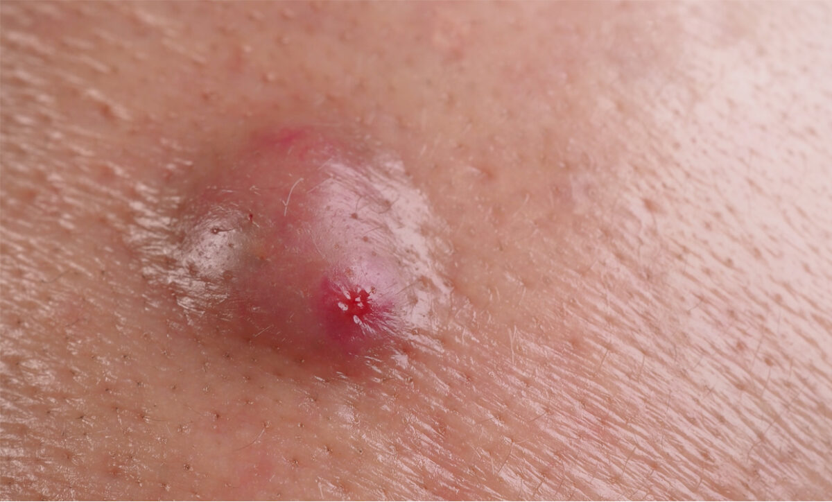 How Laser Hair Removal Works For Ingrown Hair Prone Skin