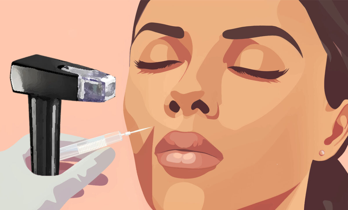 Morpheus8 and Its Impact on Dermal Fillers