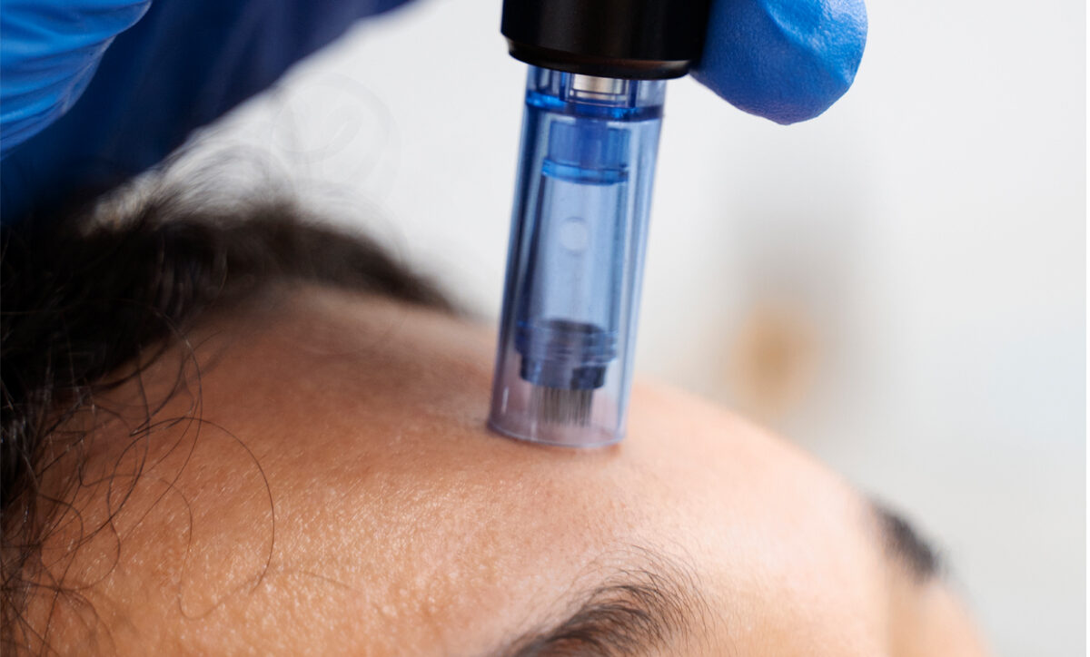 Are exosomes with microneedling worth it?