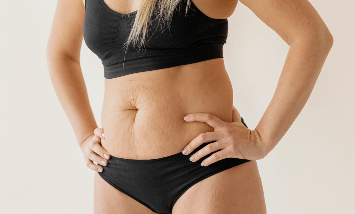 Combat loose skin after pregnancy with HIFU