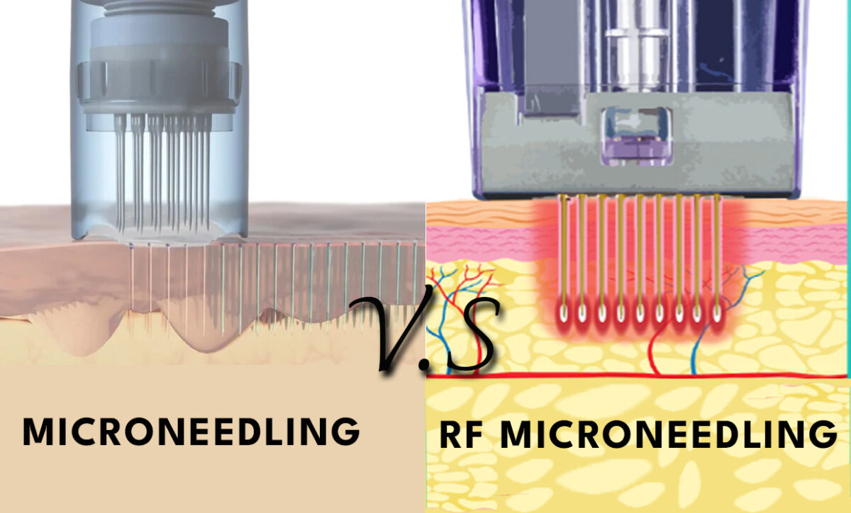 Microneedling vs RF Microneedling