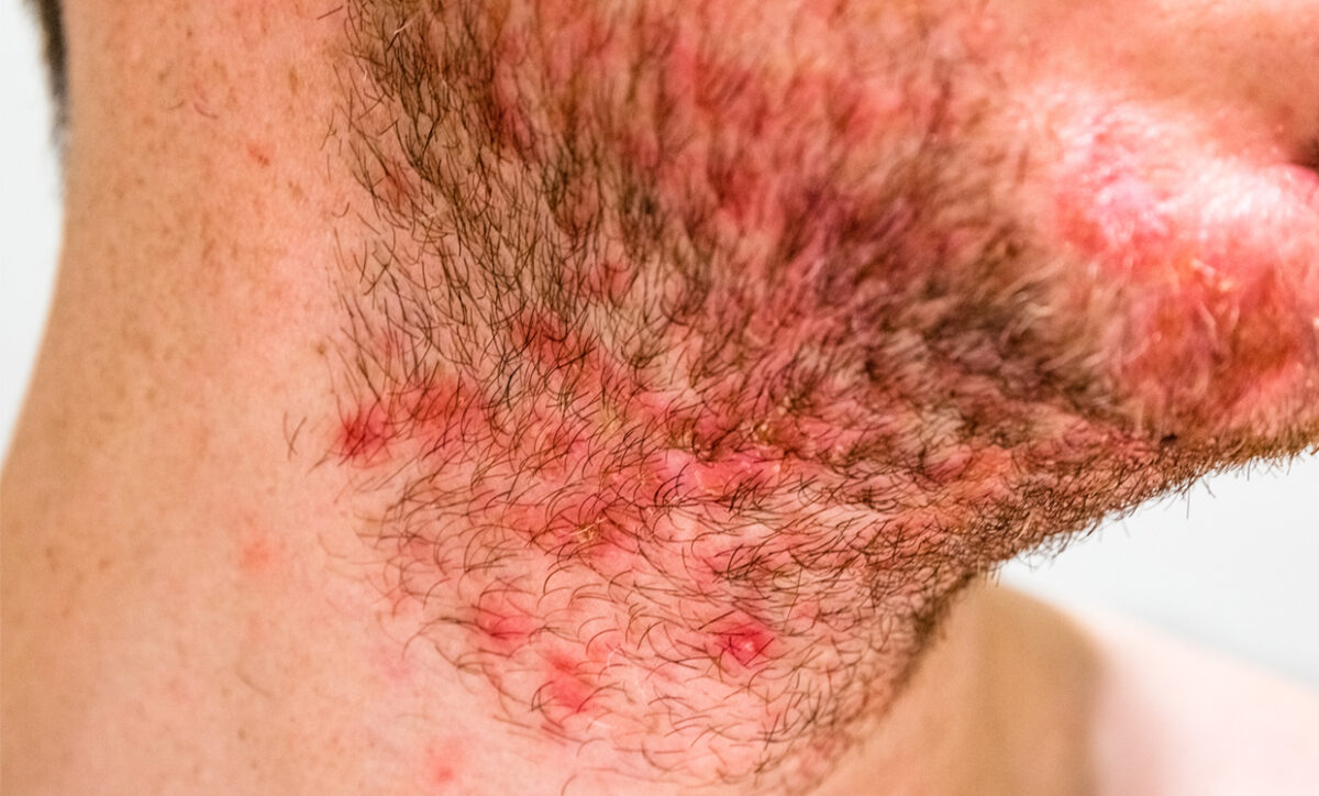 The Role of Laser Hair Removal in Managing Folliculitis