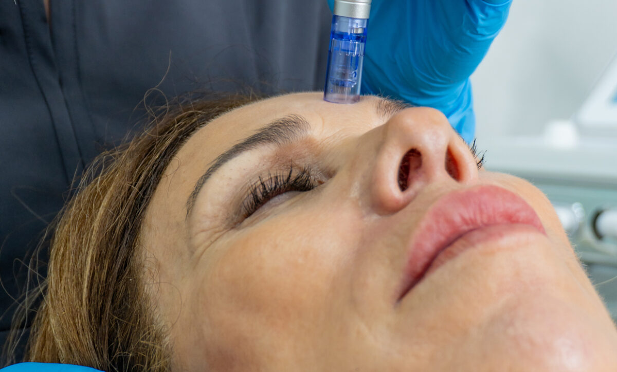 Microneedling for Hyperpigmentation and Dark Spots