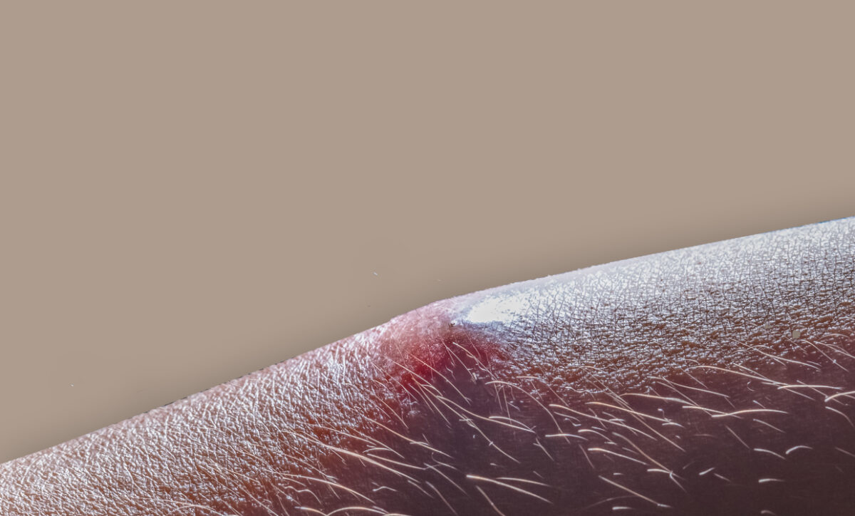Can You Squeeze an Ingrown Hair Out?