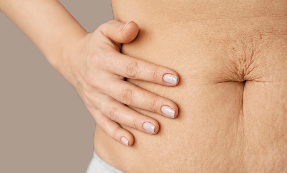 How to Get Rid of Saggy Skin After Weight Loss Injections