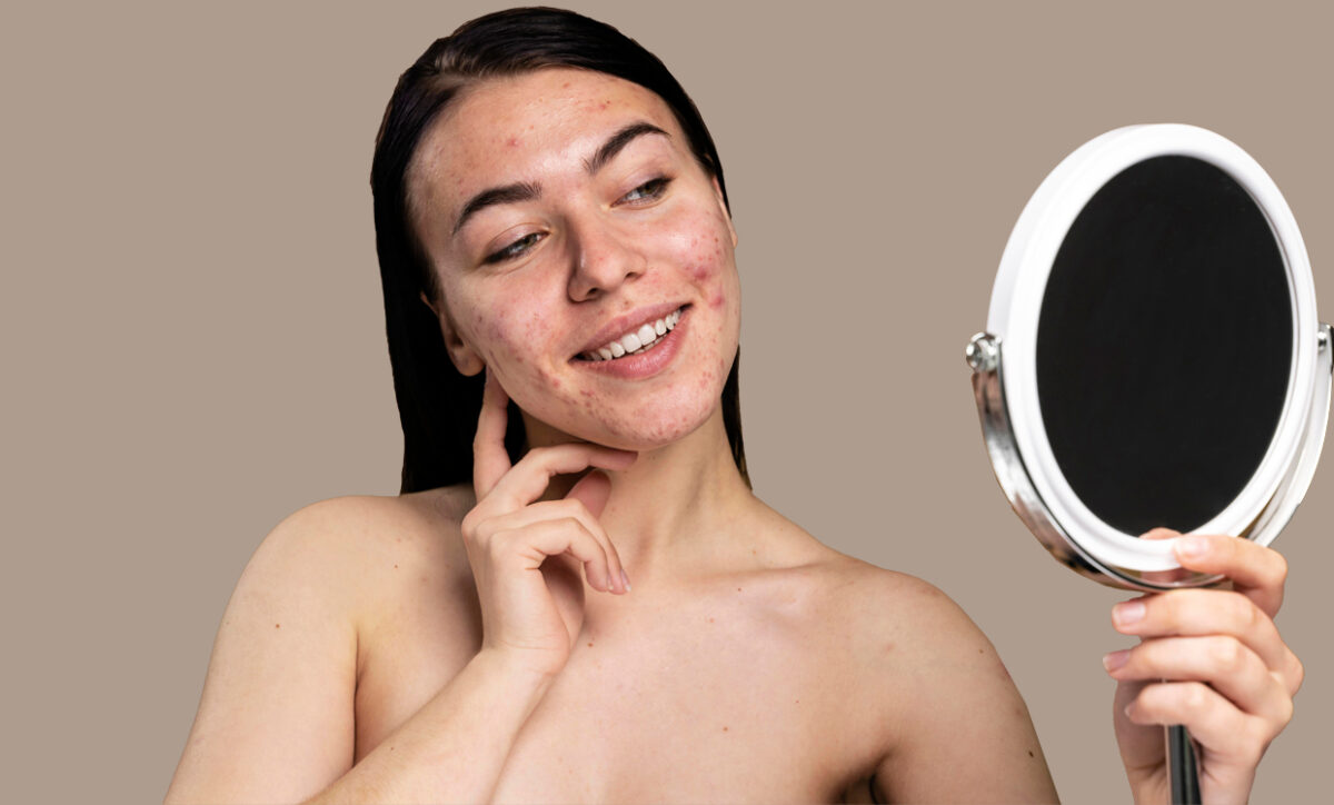 How to Tell if Acne Is Hormonal or Bacterial