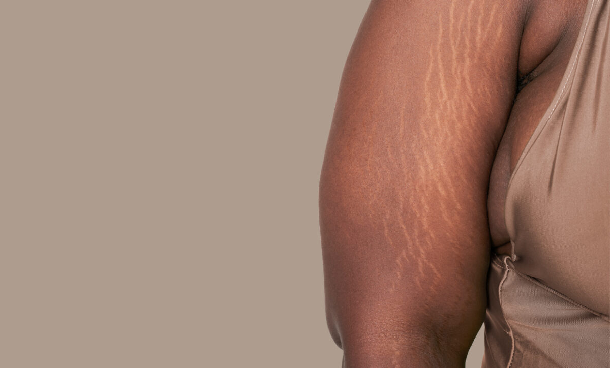 Can You 100% Get Rid of Stretch Marks?