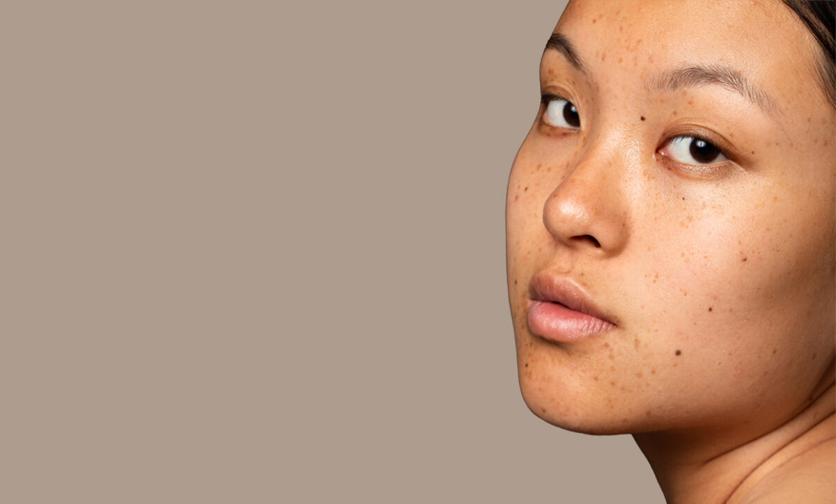 How to Remove a Dark Spot in 7 Days?