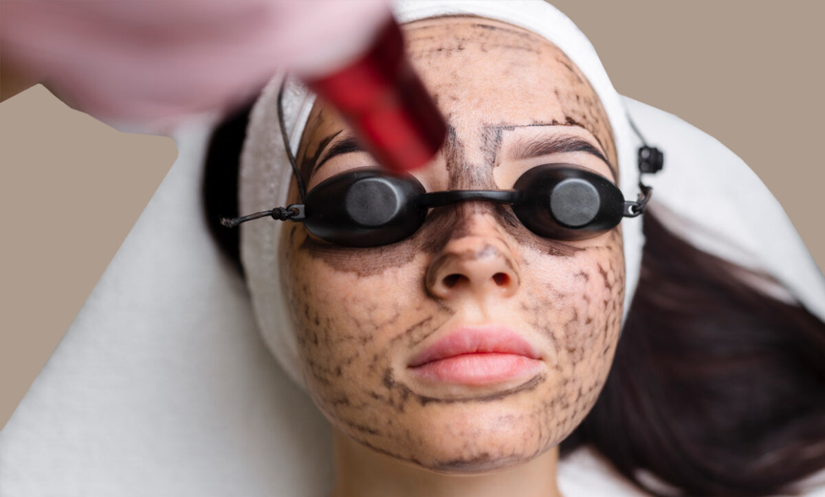 Is Carbon Facial Better Than Microneedling?