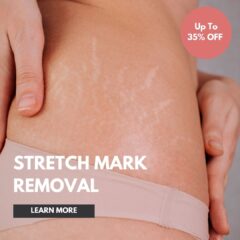stretch mark removal